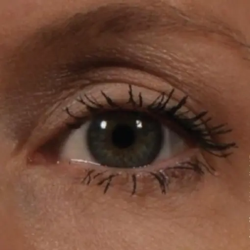 Ultherapy-eye-after