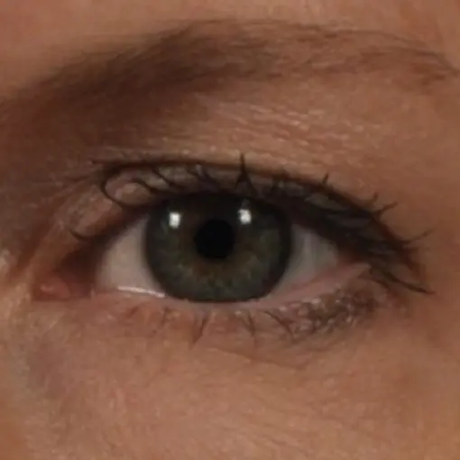 Ultherapy-eye-before