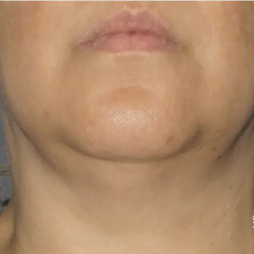 Ultherapy-neck 2-after