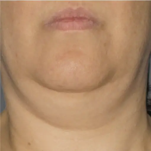 Ultherapy-neck 2-before