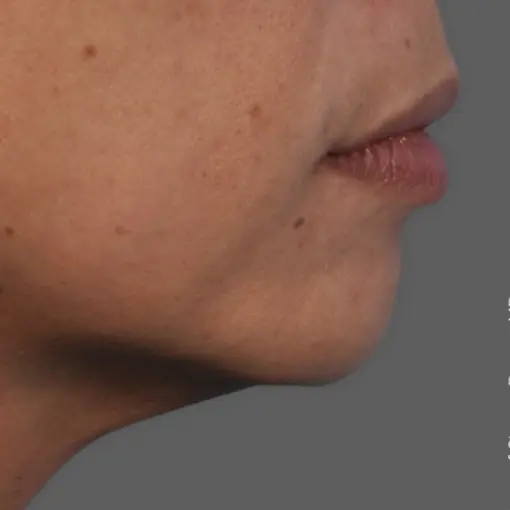 Ultherapy-neck-after