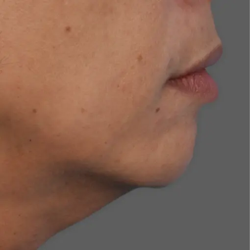 Ultherapy-neck-before