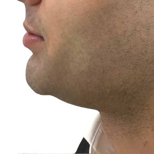 Belkyra Treatment Before After 1