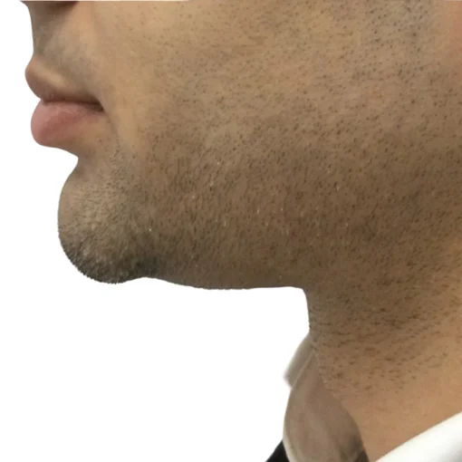 Belkyra Treatment Before After 2