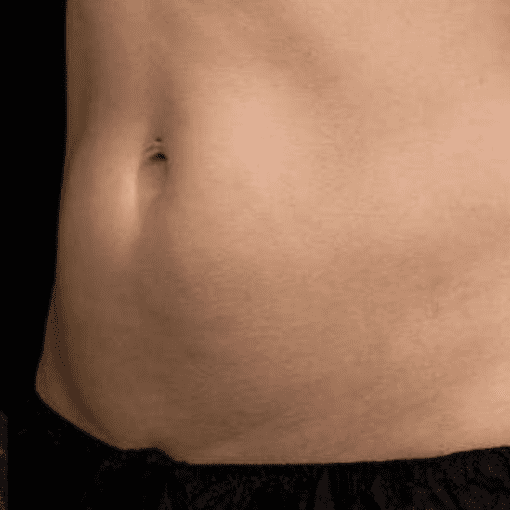 Coolsculpting after 1