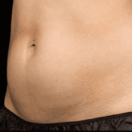 Coolsculpting before 1