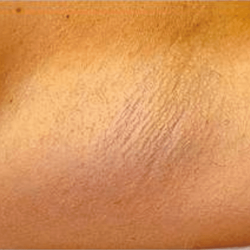 Laser hair removal after 1