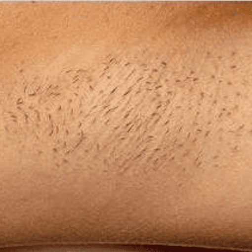 Laser hair removal before 1