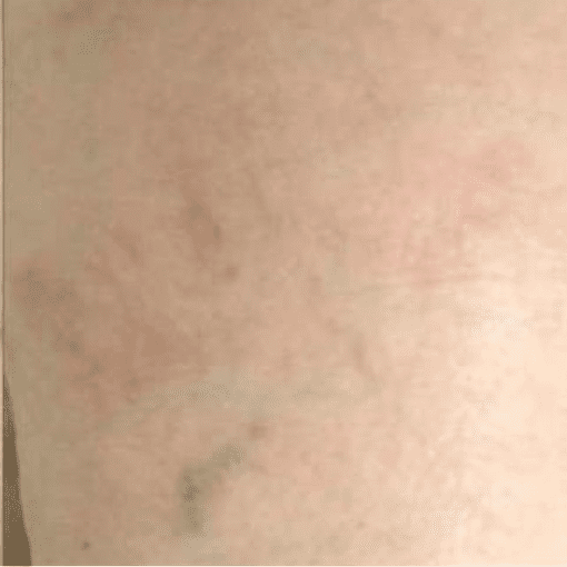 Spider Vein after 1