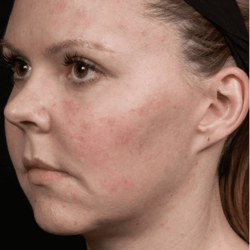 Thermage Skin Liffting after 2