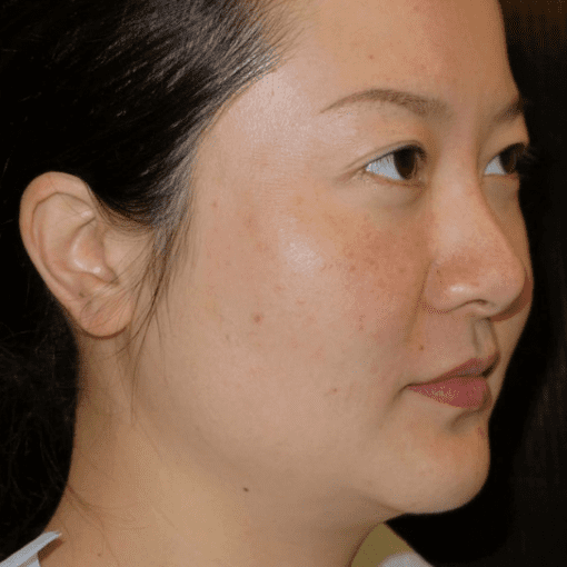 Thermage Skin Liffting after 3