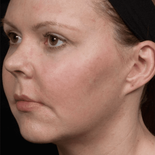 Thermage Skin Liffting before 2
