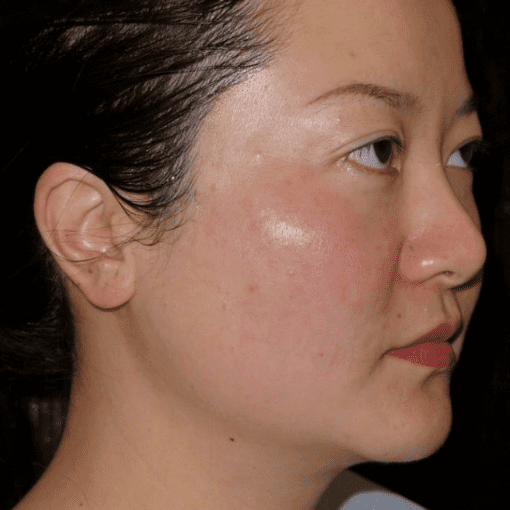 Thermage Skin Liffting before 3