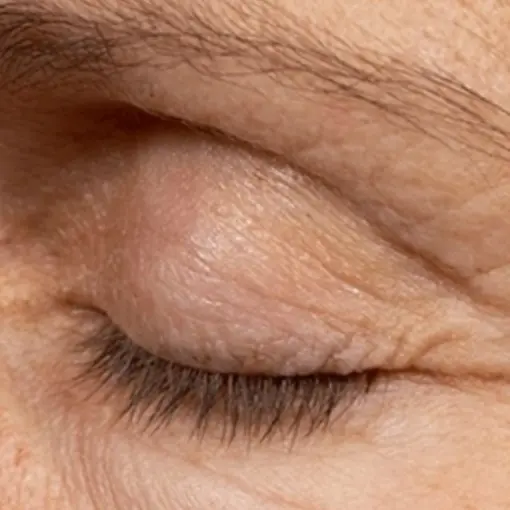 Thermage-eye-after