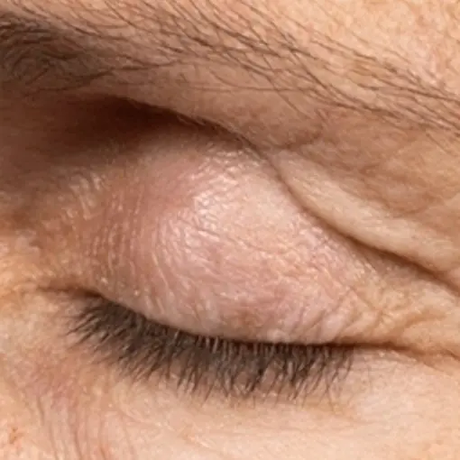 Thermage-eye-before