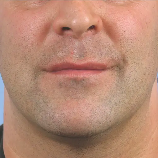 Thermage-face-after
