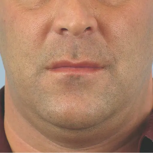 Thermage-face-before