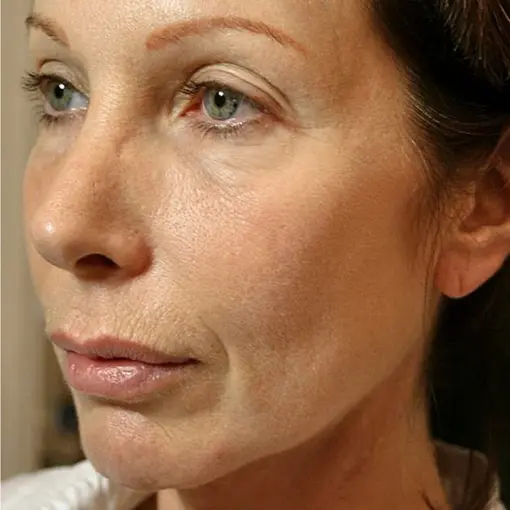 Thermage-jowl-after