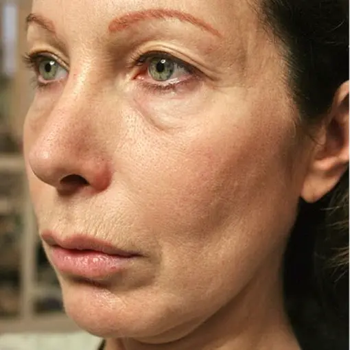 Thermage-jowl-before