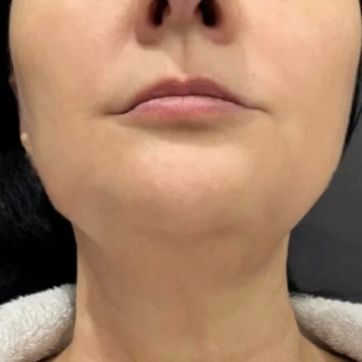 aging skin treatment-after-jawlines