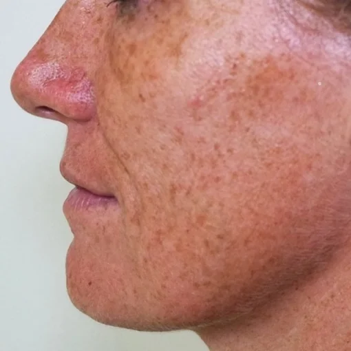 aging skin treatment-before-aging spot