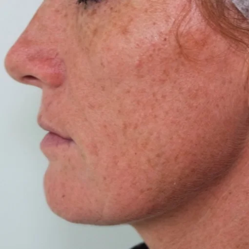 aging skin treatment-after-aging spot
