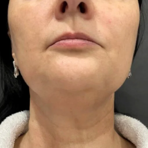 aging skin treatment-before-jawlines