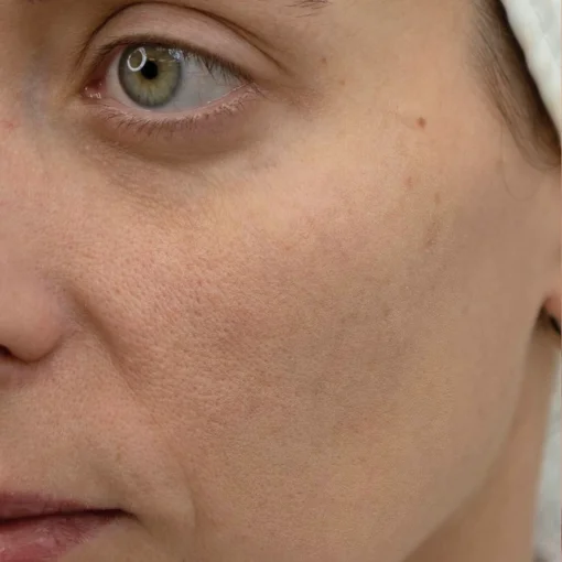 aging skin treatment-before-skin texture