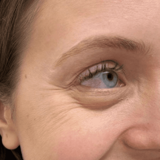 botox before 3
