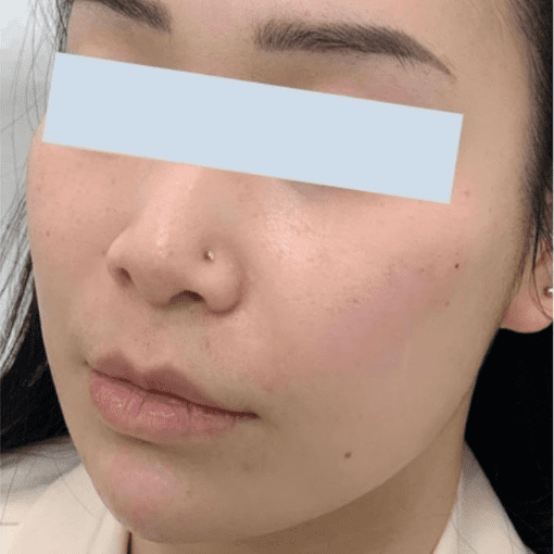dermal filler after 1
