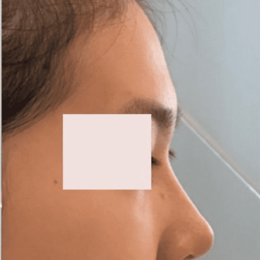 dermal filler after 2