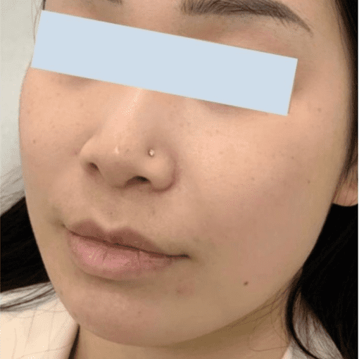dermal filler before 1