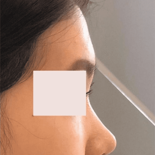 dermal filler before 2