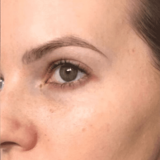 mesotherapy after 1