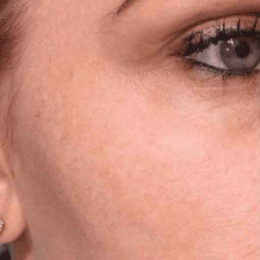 mesotherapy after 2