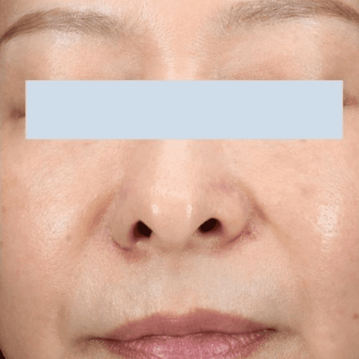 mesotherapy after 3