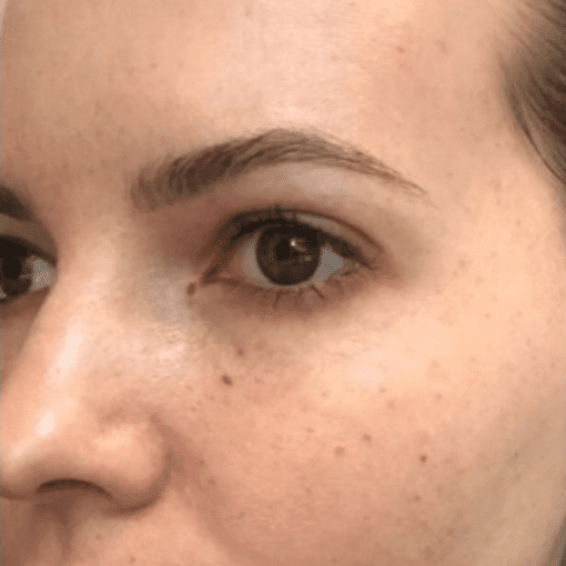 mesotherapy before 1