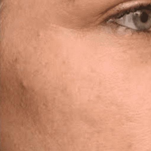 mesotherapy before 2