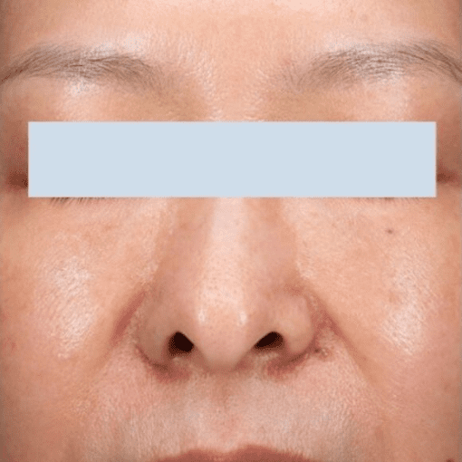 mesotherapy before 3