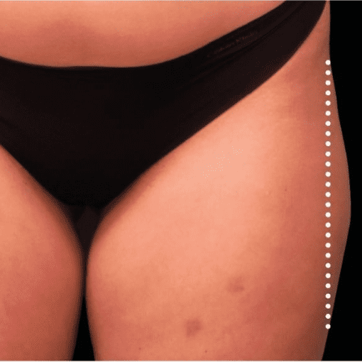 sculptra butt lift after 1