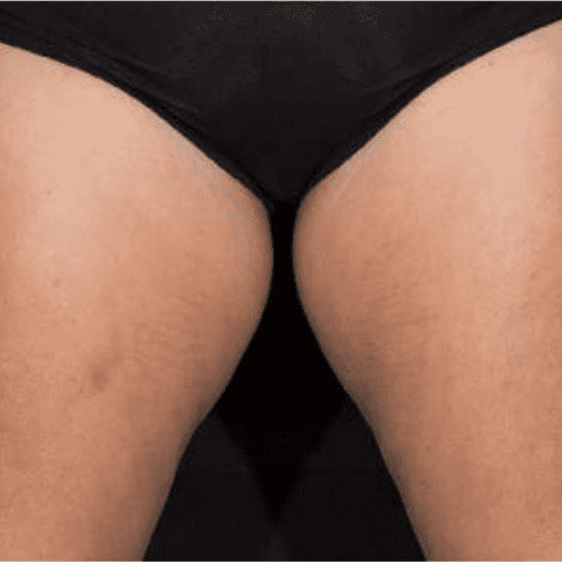 sculptra butt lift after 2