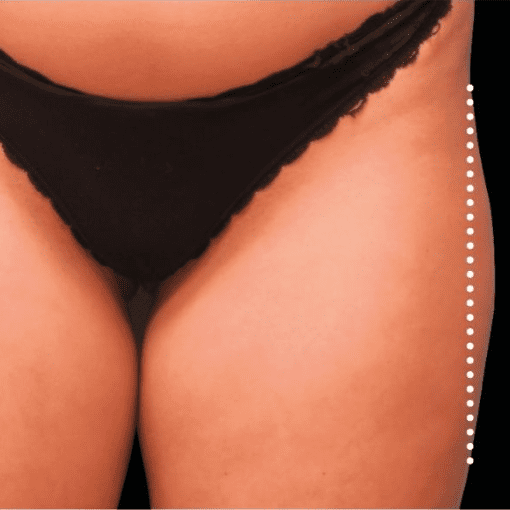 sculptra butt lift before 1