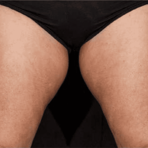 sculptra butt lift before 2