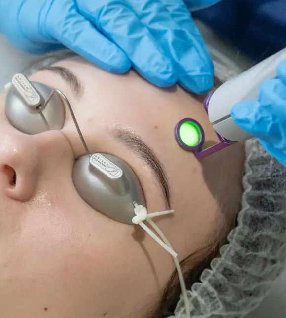 vbeam perfecta laser-laser for Rosacea redness-signature cosmetic clinic