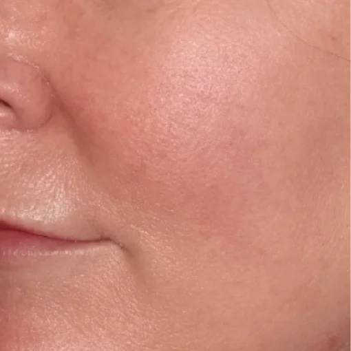 vbeam laser-Rosacea-after