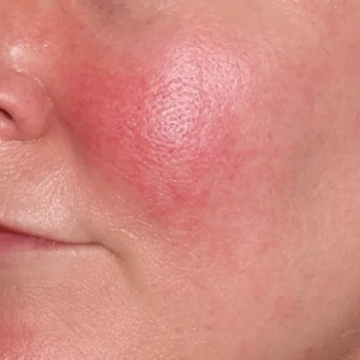 vbeam laser-Rosacea-before