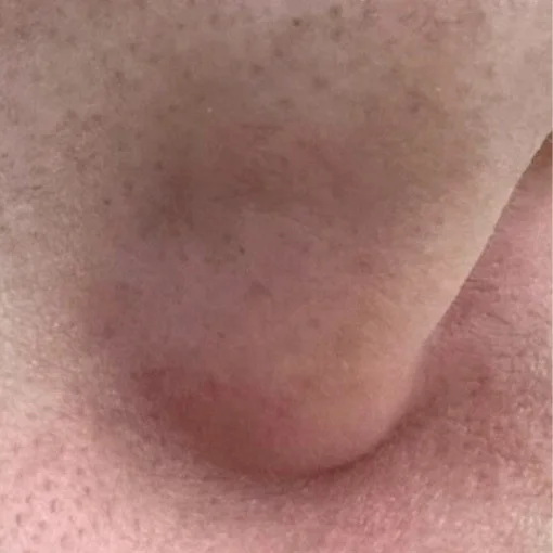 vbeam laser-nose-after
