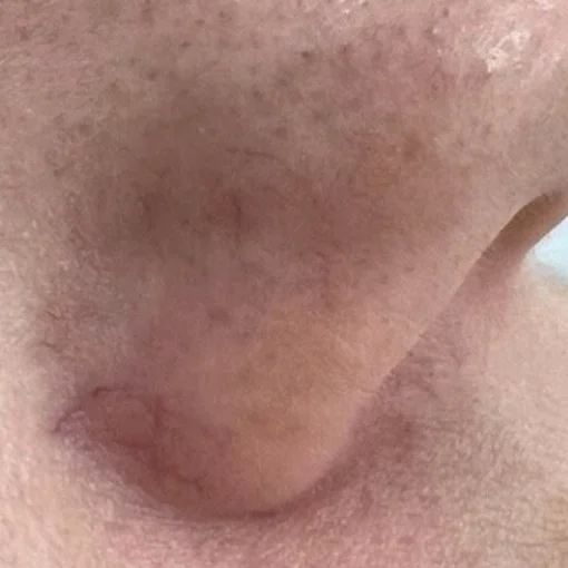 vbeam laser-nose-before
