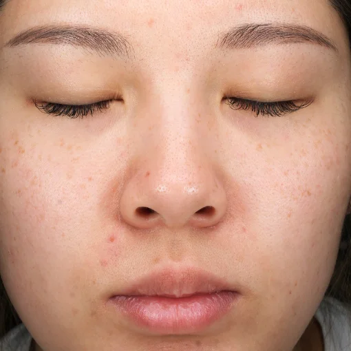 vbeam laser-skin redness-after