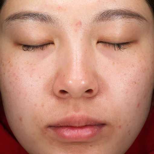 vbeam laser-skin redness-before